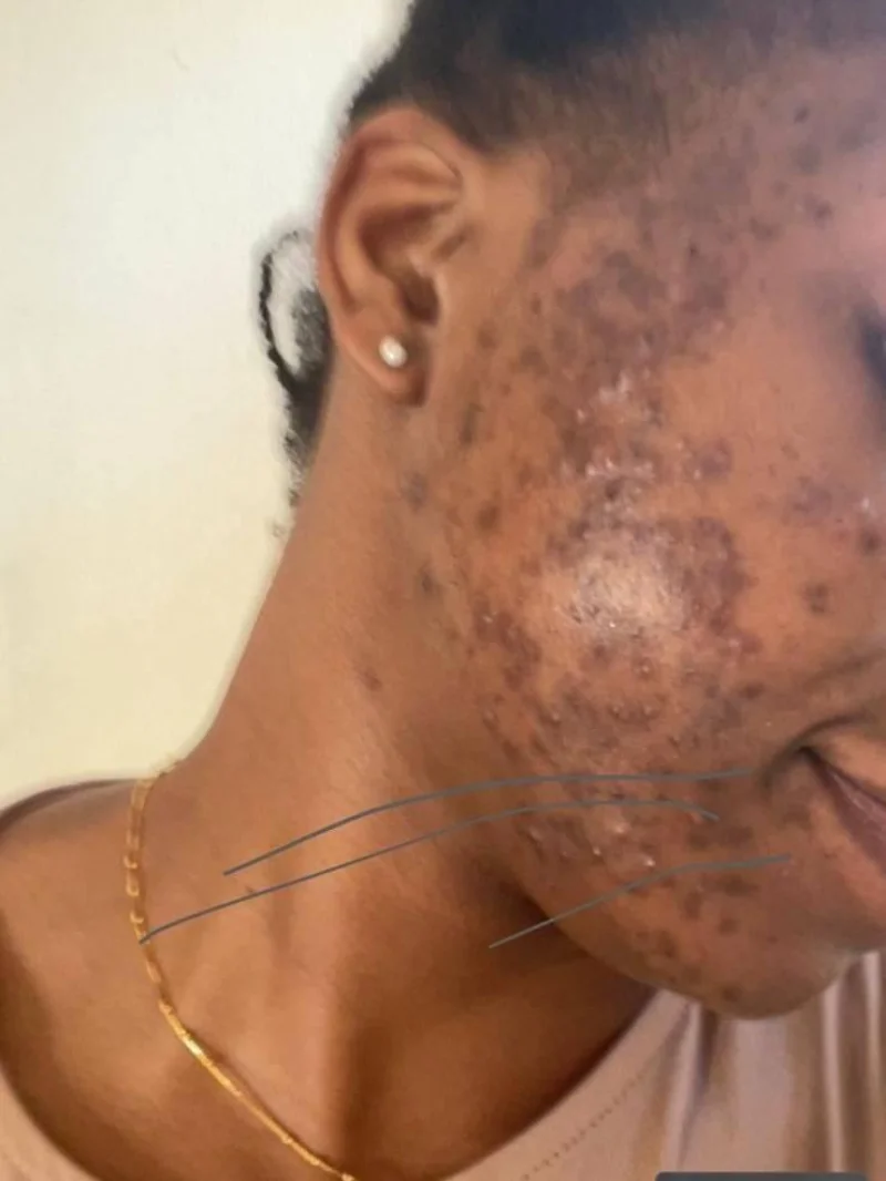 Glav Spa treatment result image 7