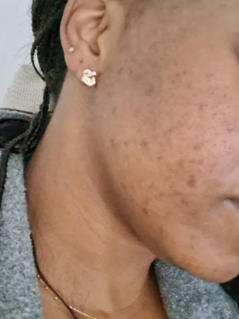 Glav Spa treatment result image 8